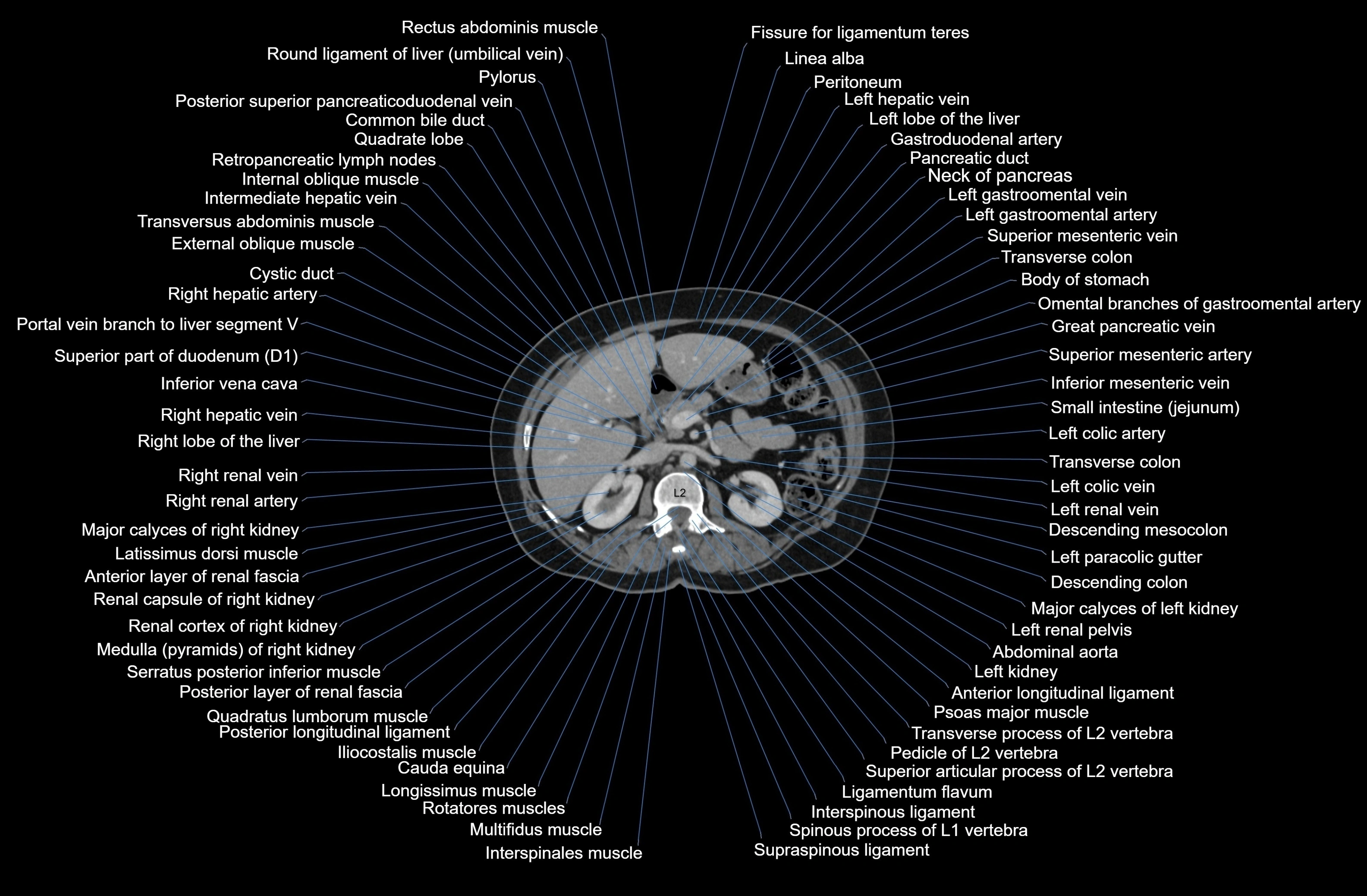 CT Abdomen axial cross sectional anatomy labelled radiology image-00032.webp
